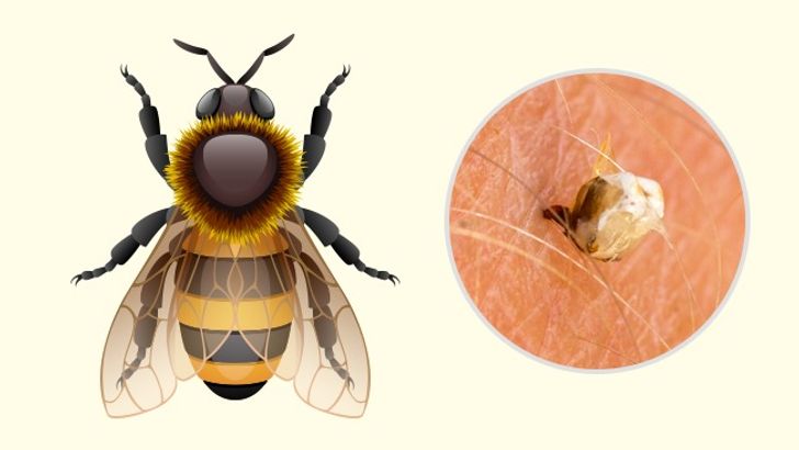 10 Bug Bites Anyone Should Be Able to Identify 4 Usa People 10 Bug Bites Anyone Should Be Able to Identify