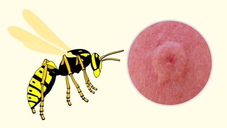 10 Bug Bites Anyone Should Be Able to Identify 5 Usa People 10 Bug Bites Anyone Should Be Able to Identify