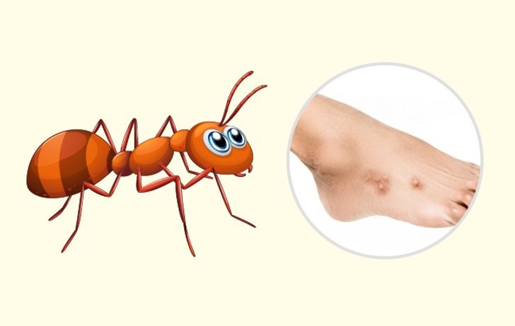 10 Bug Bites Anyone Should Be Able to Identify 9 Usa People 10 Bug Bites Anyone Should Be Able to Identify