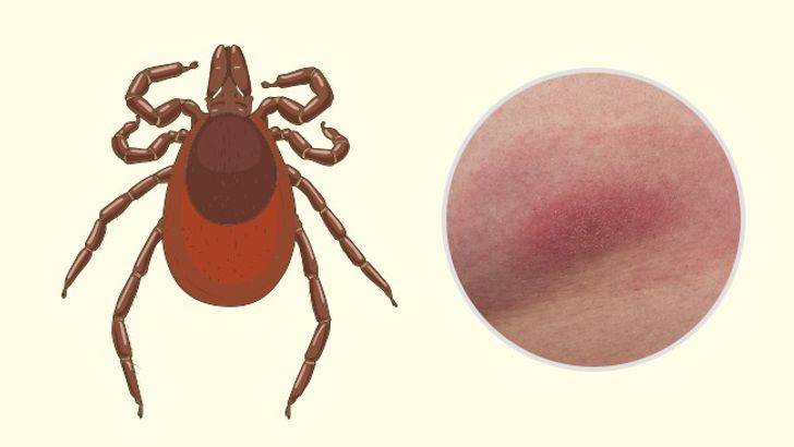 10 Bug Bites Anyone Should Be Able to Identify 7 Usa People 10 Bug Bites Anyone Should Be Able to Identify