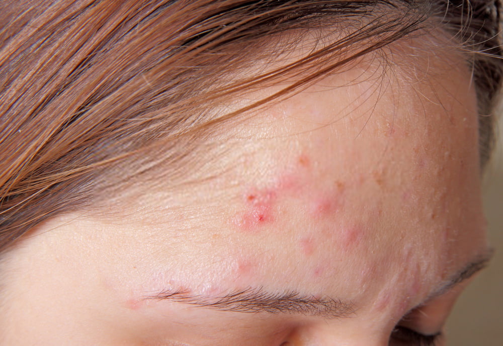 Treatment For Pimples On Forehead – 12 Best Home Cures