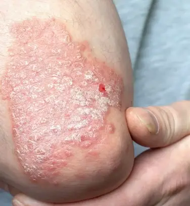5 Warning Signs of Psoriasis You Shouldn’t Ignore