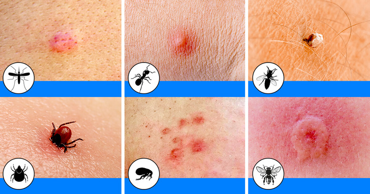 10 Bug Bites Anyone Should Be Able to Identify 2 Usa People 10 Bug Bites Anyone Should Be Able to Identify