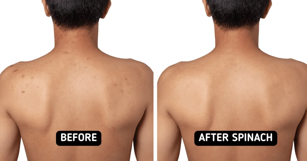 Body Acne: 10 Tips To Get Rid Of Them 11 Usa People Body Acne: 10 Tips To Get Rid Of Them