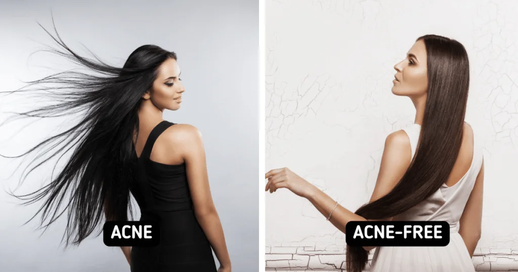 Body Acne: 10 Tips To Get Rid Of Them 5 Usa People Body Acne: 10 Tips To Get Rid Of Them